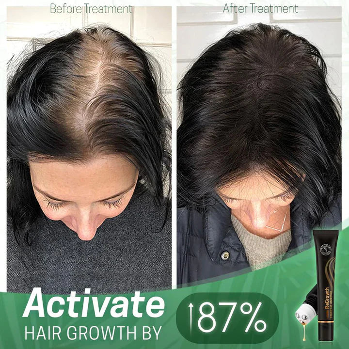 NextGrow™ Prevents bald spots | TODAY ONLY 1 + 1 FREE