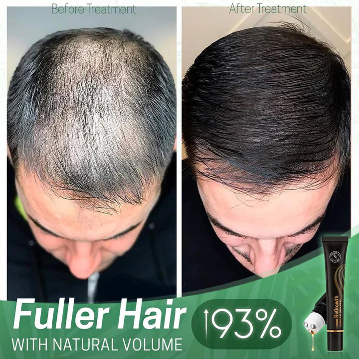 NextGrow™ Prevents bald spots | TODAY ONLY 1 + 1 FREE