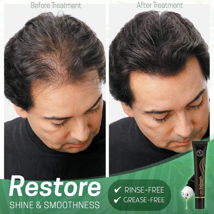 NextGrow™ Prevents bald spots | TODAY ONLY 1 + 1 FREE