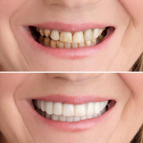 1 + 1 Free | SmileFix™ Create the perfect teeth