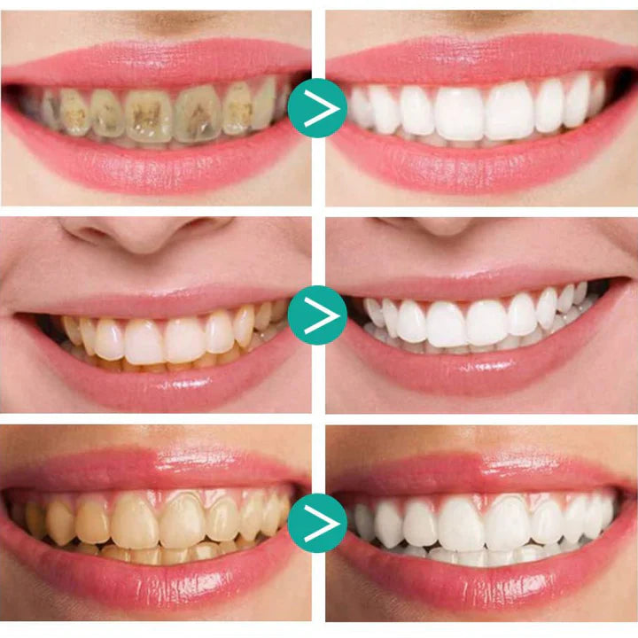 WhiteSmile™ - The solution against yellow teeth! | Temporary 1 + 1 Free