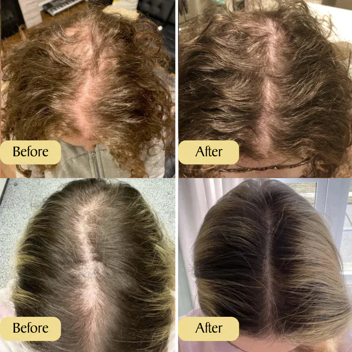 Carvenchy™ Prevention of Hair Loss | Temporarily 1+1 Free